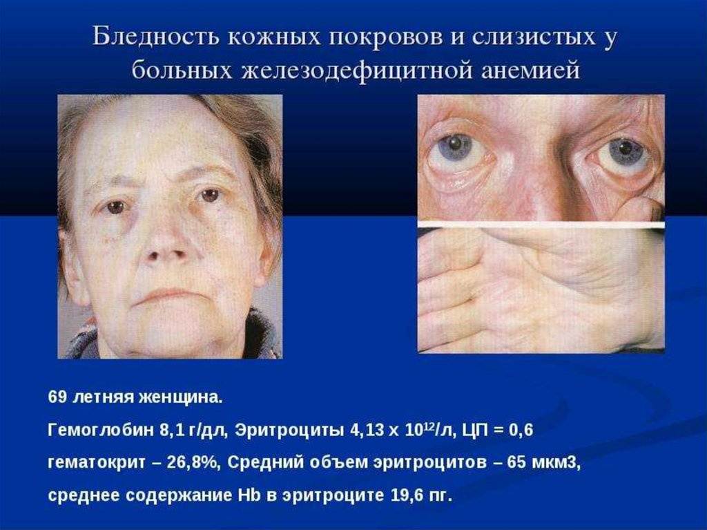 Эту фотографию я взяла из открытого доступа в Яндексе, выходит по запросу - Анемия у пожидой женщины.