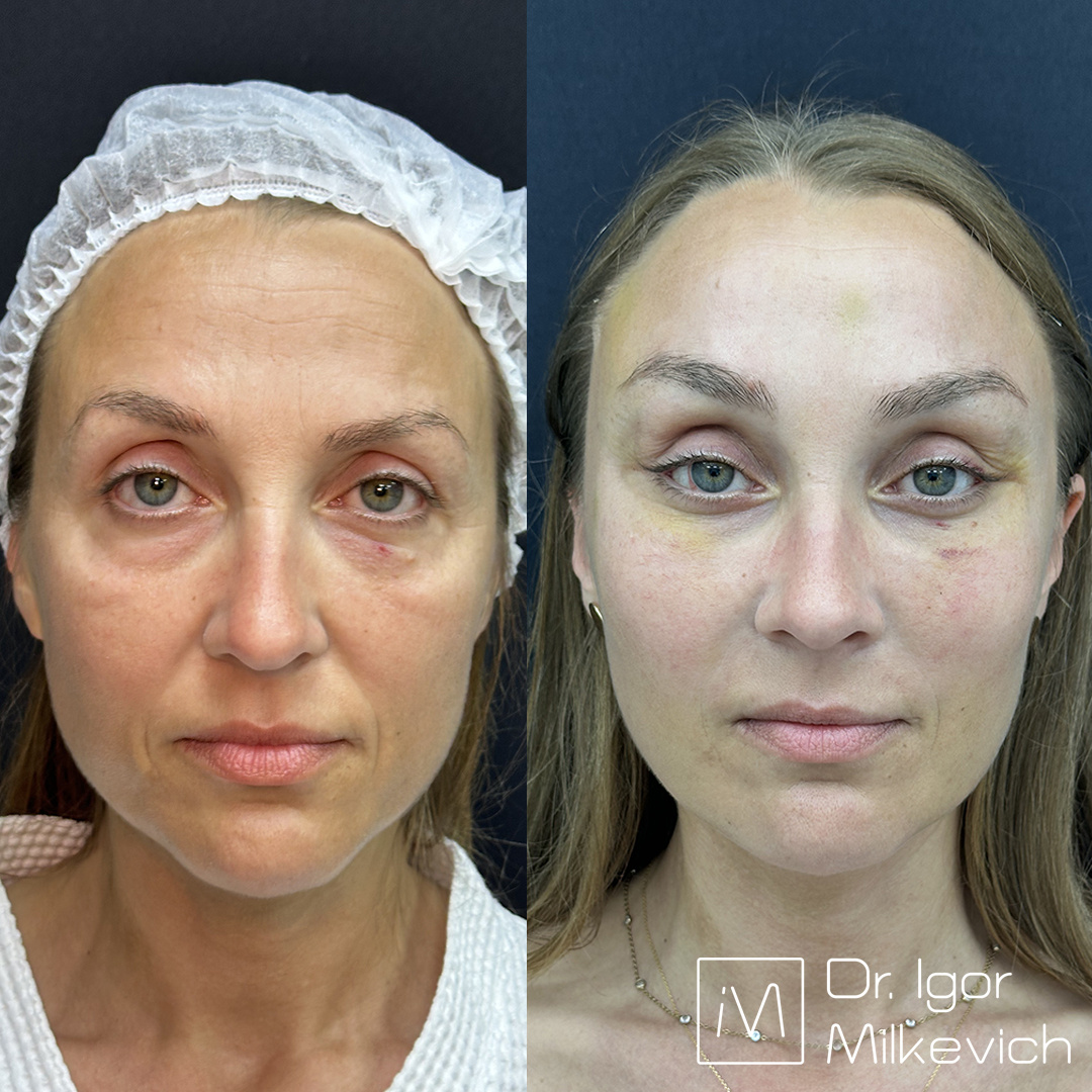 7 дней после периорбитопластики