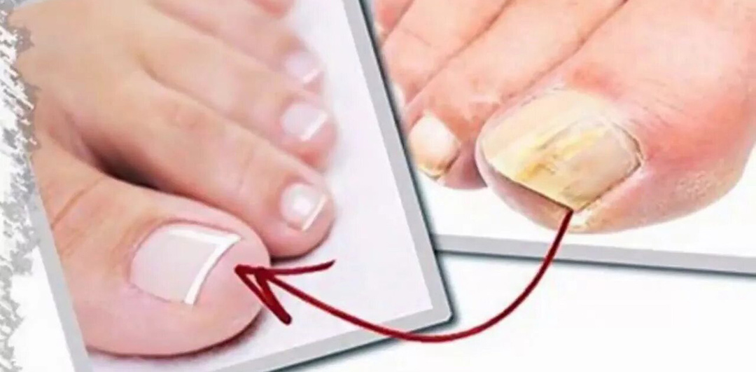 Пожелтел и крошится ноготь? Это онихомикоз. Как лечить, чтобы не заразить всю семью