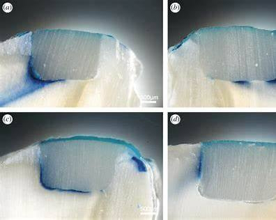 Микроподтёки между дентином и композитной реставрацией после термической нагрузки 