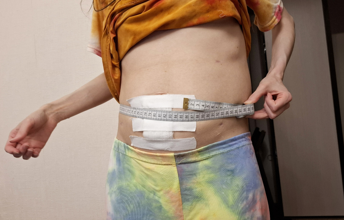 Живот через неделю после лапароцентеза