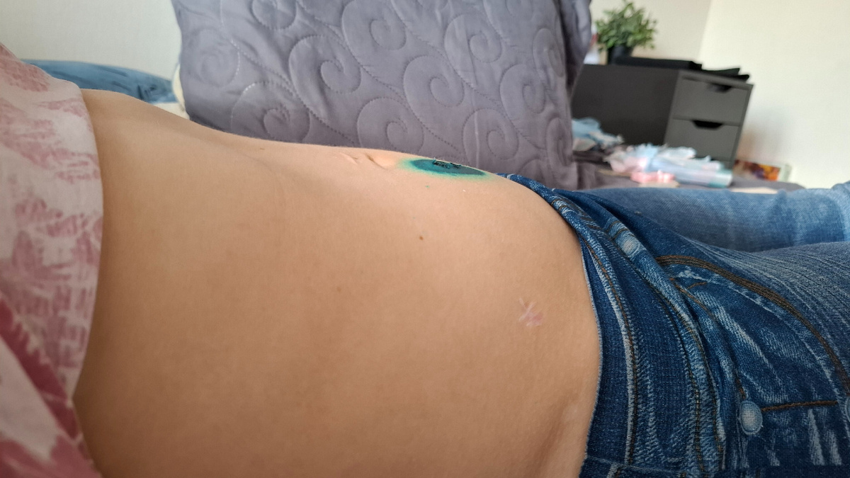 Живот через неделю после лапароцентеза (втянутый)