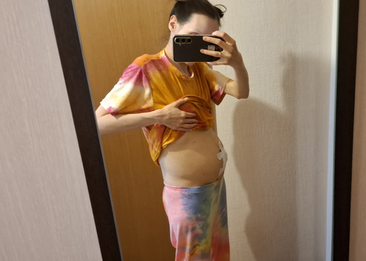 Асцит вырос после третьего лапароцентеза