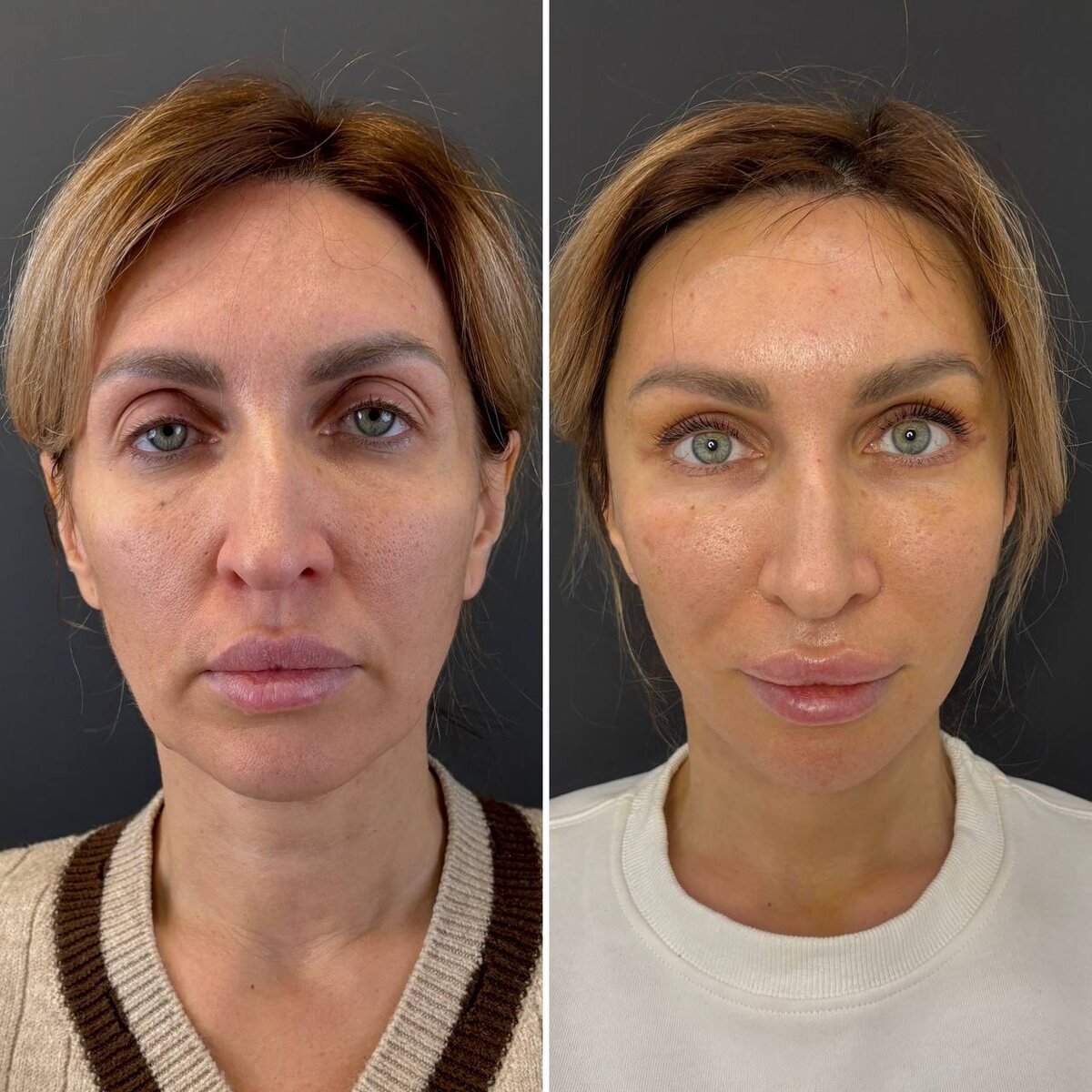 12е сутки после хирургического омоложения лица. Хирург к.м.н. Остринская Т. В.