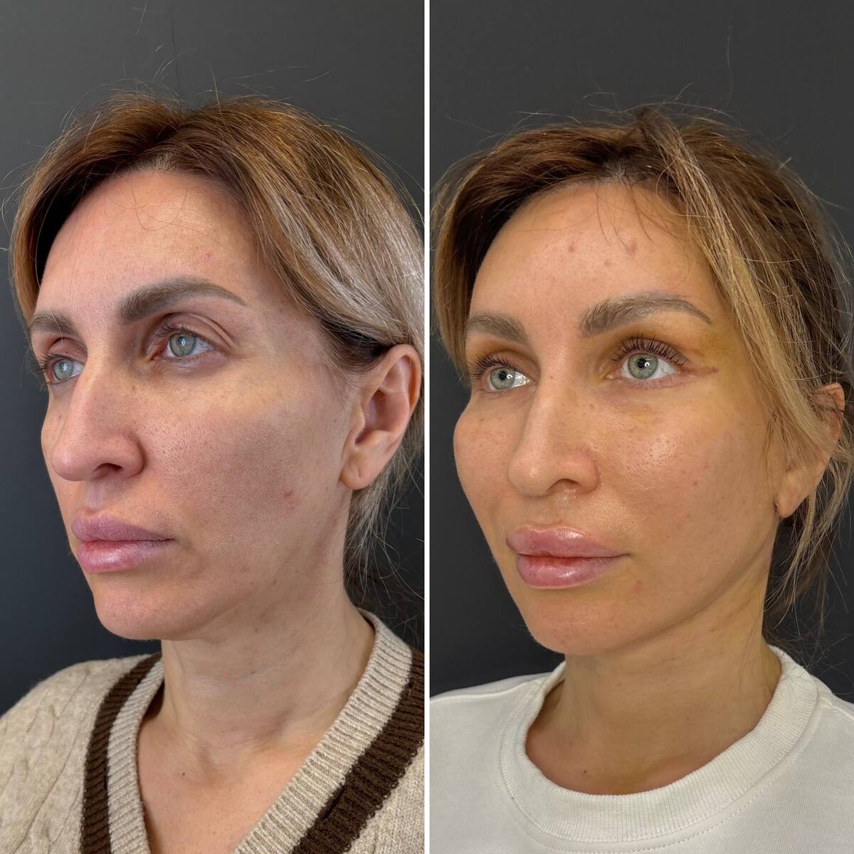 12е сутки после хирургического омоложения лица. Хирург к.м.н. Остринская Т. В.