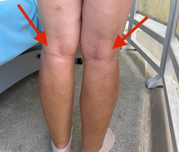 "Шишка под коленом": медицинские страшилки и уколы в сустав