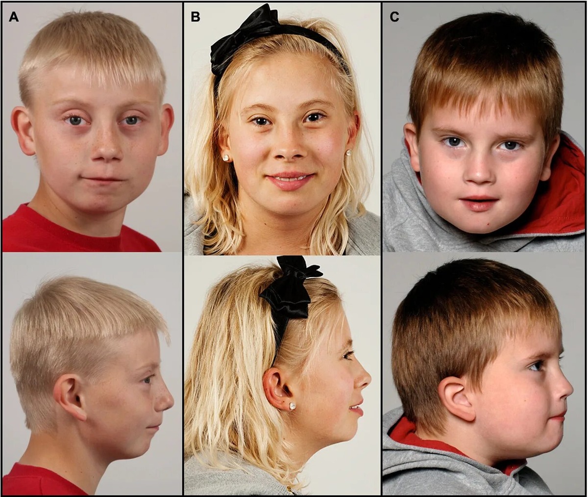 Последствия синдрома делеции