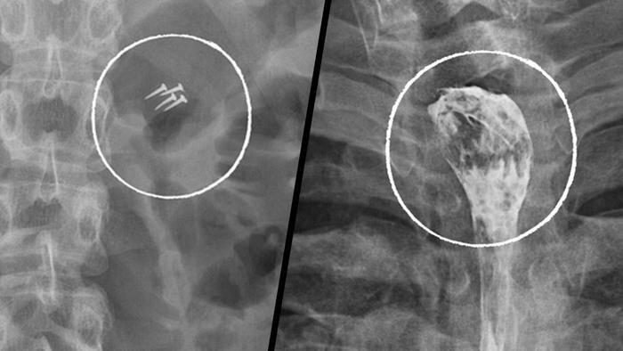Извлечённые предметы из пациентов НИИ скорой помощи имени Н. В. Склифосовского. Обложка © Telegram / Склиф