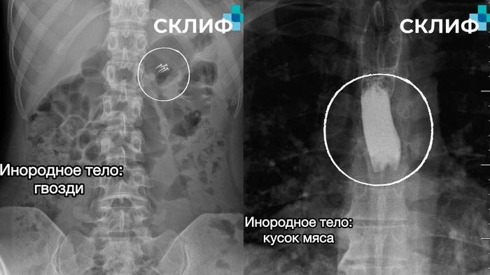 Извлечённые предметы из пациентов НИИ скорой помощи имени Н. В. Склифосовского. Фото © Telegram / Склиф