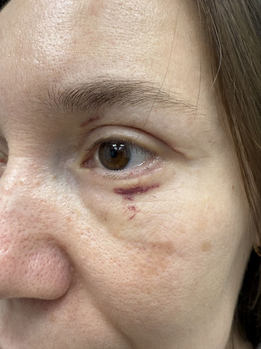 21 день после операции 