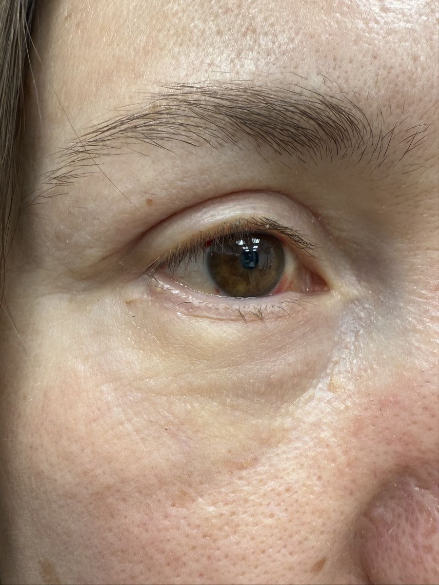 21 день после операции 