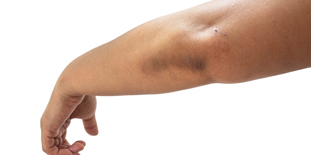 Кожа на локтях потемнела: почему это не просто сухость