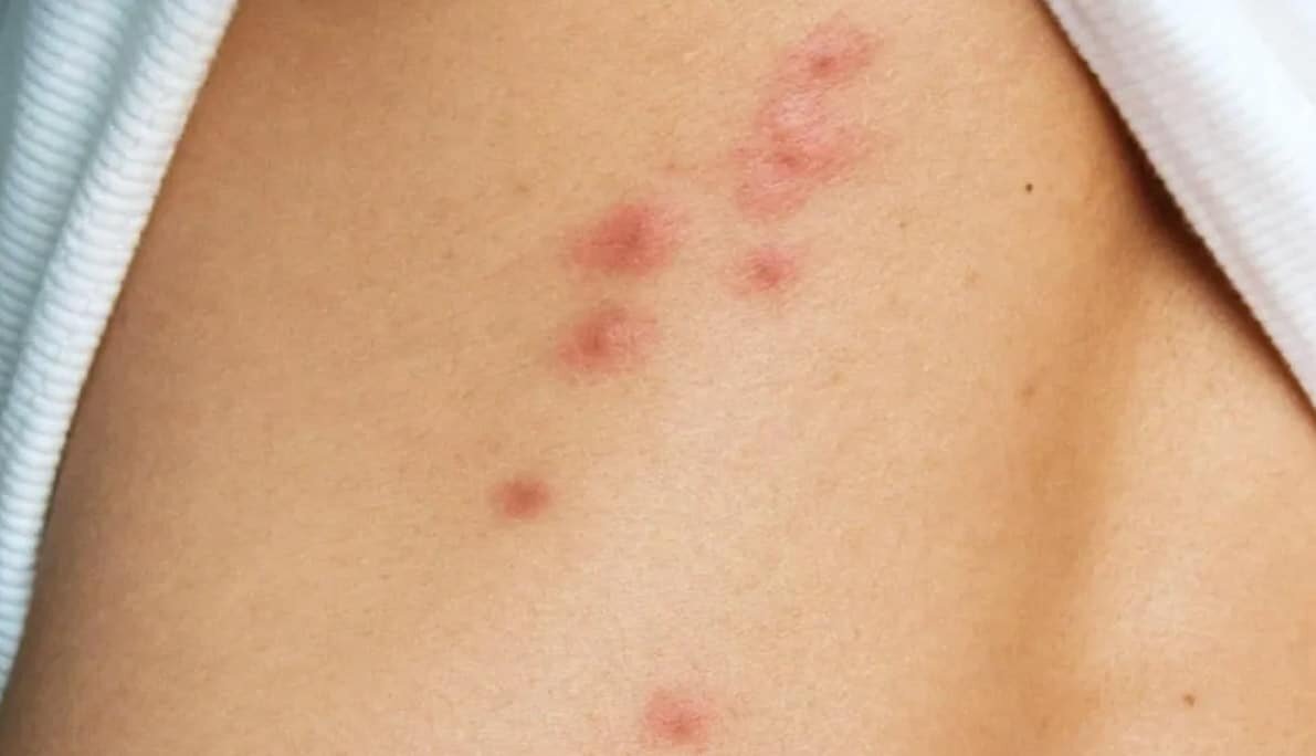 Укусы клопов: как распознать и избавиться от паразитов