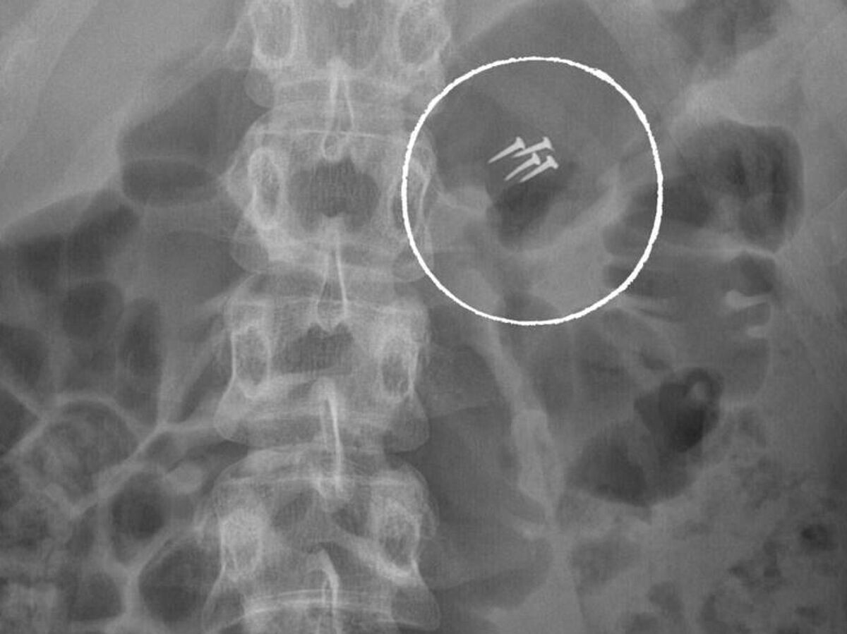    НИИ им. Склифосовского опубликовал самые интересные находки в пациентах | © Склиф/Telegram