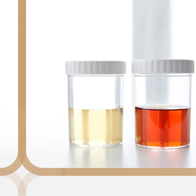 Кровь в моче