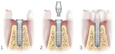 Изображение с ресурса https://ionika-dent.ru/
