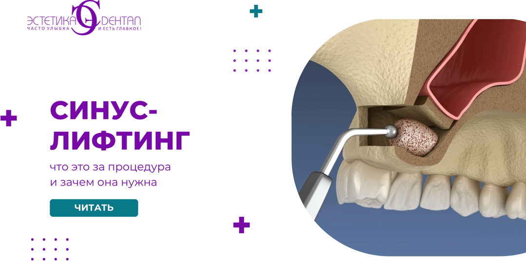 Синус-лифтинг: что это за процедура и зачем она нужна