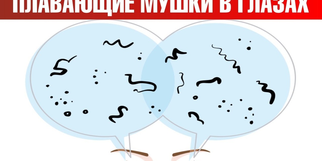 Мушки перед глазами: когда это не давление