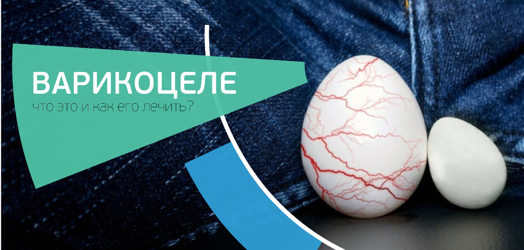 Варикоцеле у мужчин. Что это и как его лечить?