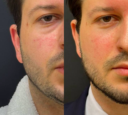 Месяц после операции