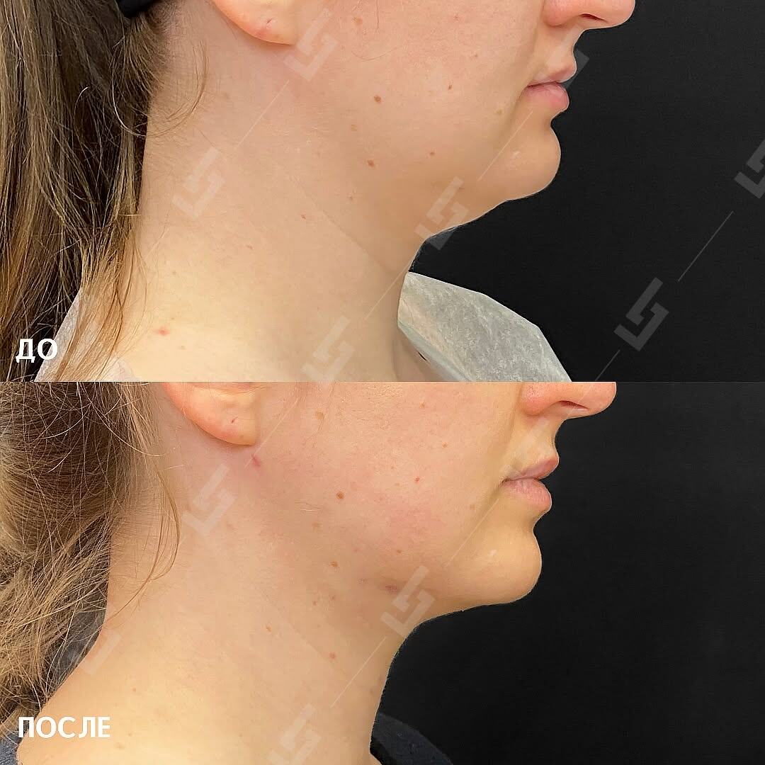 Прцедура FaceTite