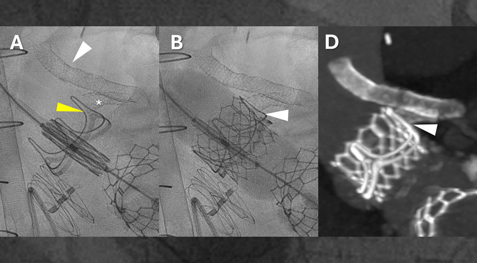   Christopher G. Bruce et al. / Circulation: Cardiovascular Interventions, 2026