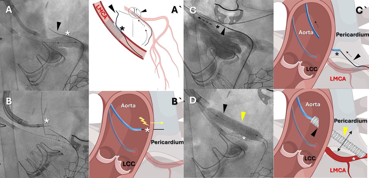   Christopher G. Bruce et al. / Circulation: Cardiovascular Interventions, 2026