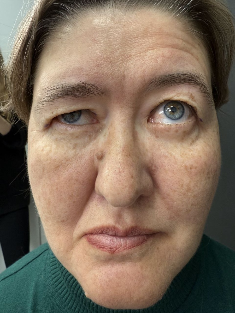 До операции 