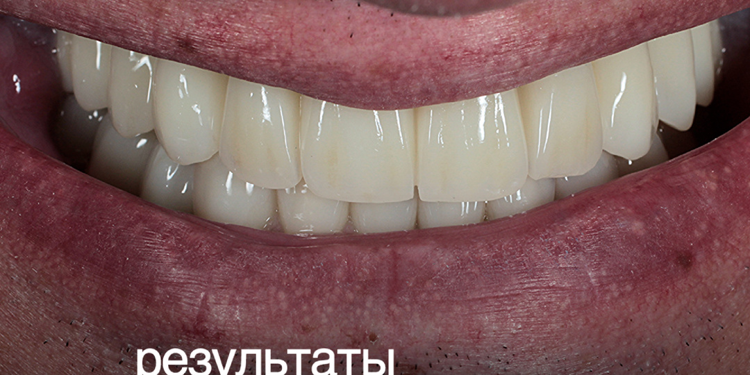Апгрейд улыбки у пациента 52-х лет