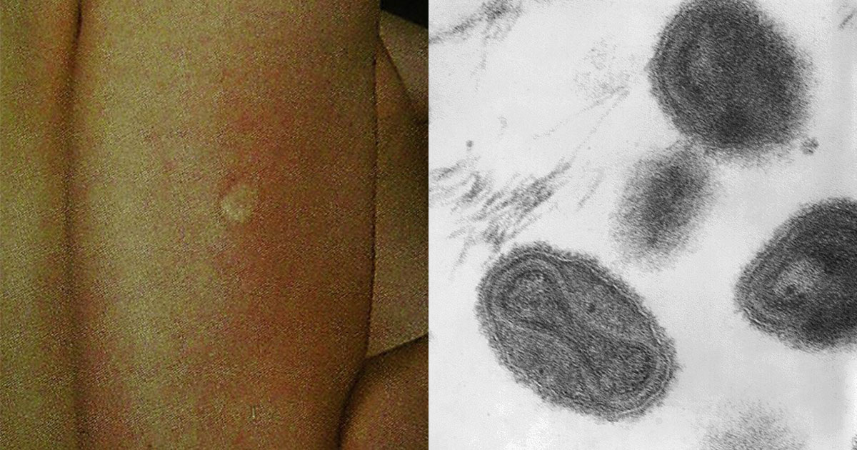 シトラマタand Dr. Fred Murphy & Sylvia Whitfield / CDC