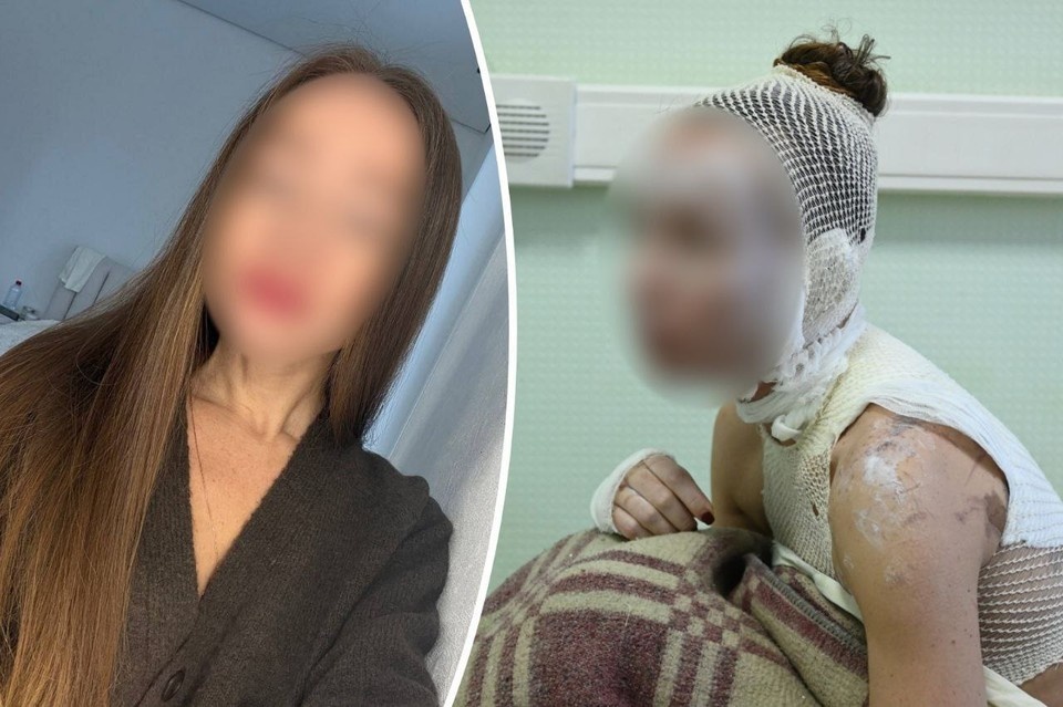    Алене предстоит долгое лечение после полученных ожогов. Фото: соцсети Ольга ЮШКОВА