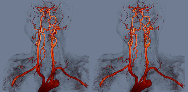 МРТ или КТ сосудов головы и шеи: Какой метод выбрать и что покажут результаты