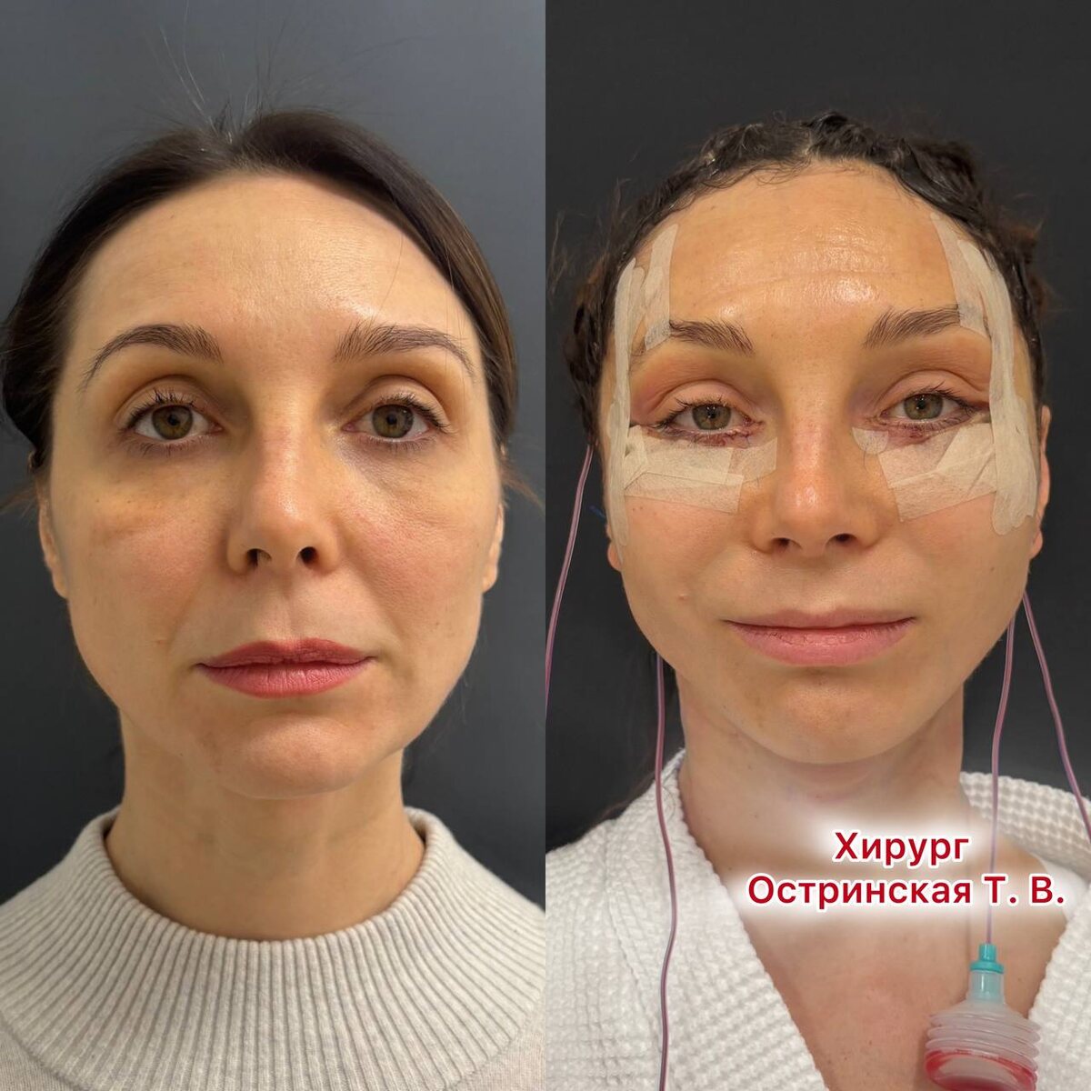 Пациентка на 1-е сутки после эндоскопического лифтинга лица. Хирург Остринская Т. В. 