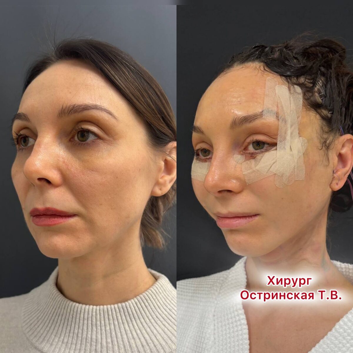 Пациентка на 1-е сутки после эндоскопического лифтинга лица. Хирург Остринская Т. В. 