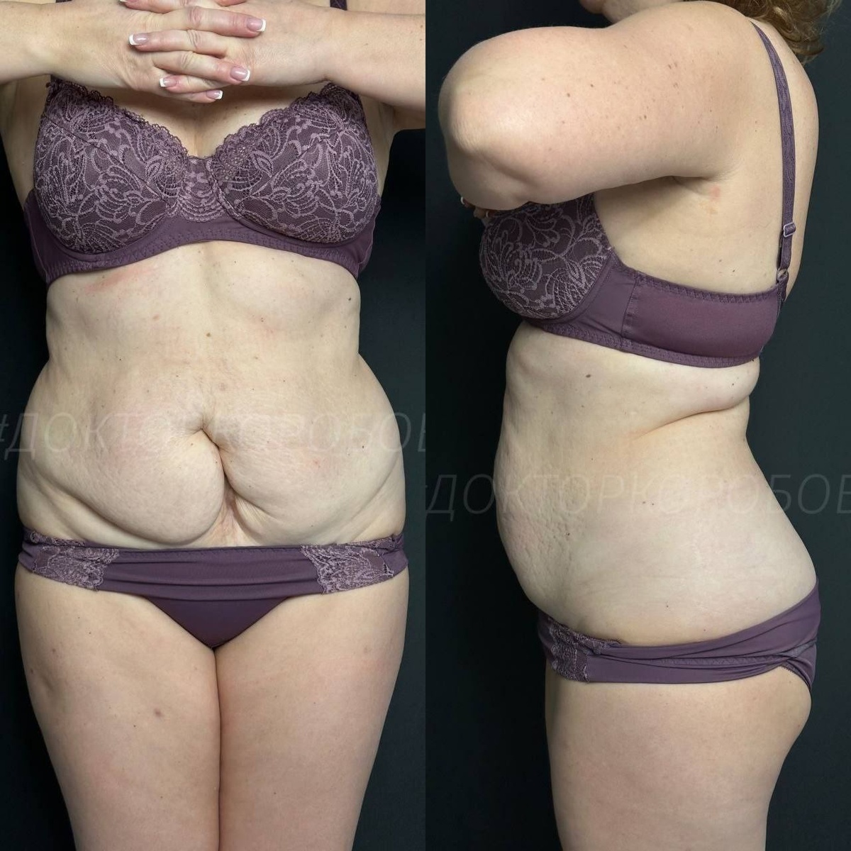 Фото ДО операции