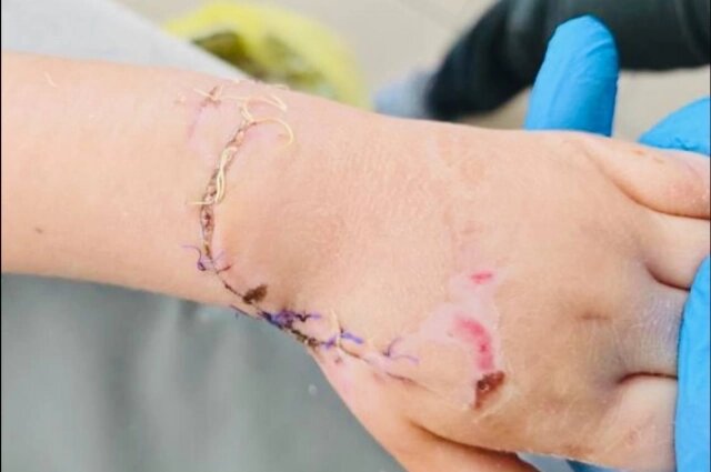    Теперь ручка девочки выглядит почти восстановленной. Фото: Минздрав Приморского края