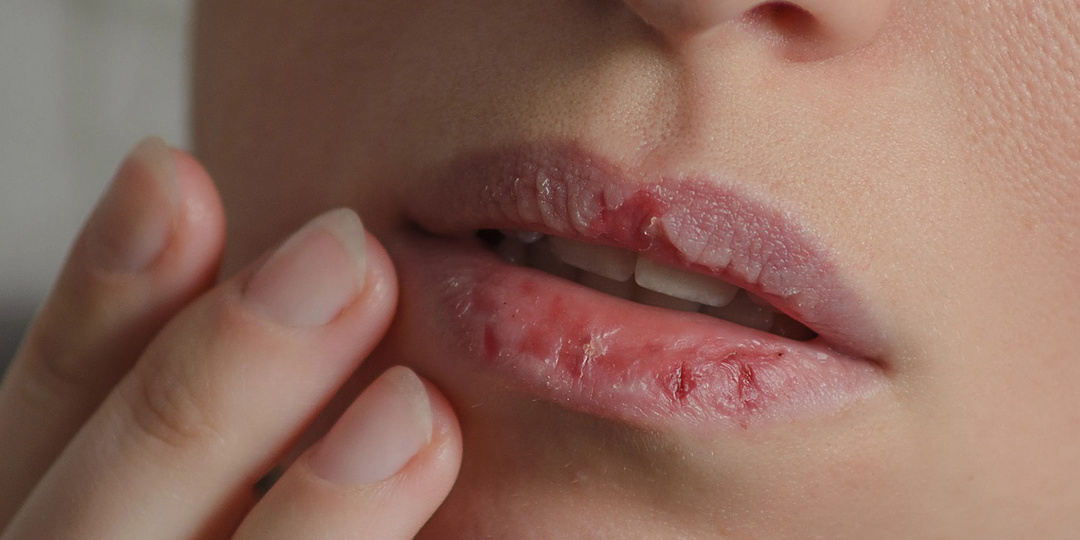 Постоянно сохнут и трескаются губы? Возможно, это хейлит, а не обветривание