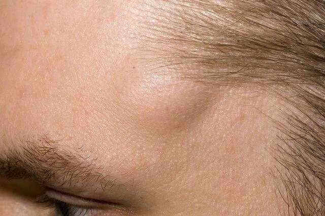 Шишки под кожей: что такое липомы, опасны ли они и стоит ли их удалять