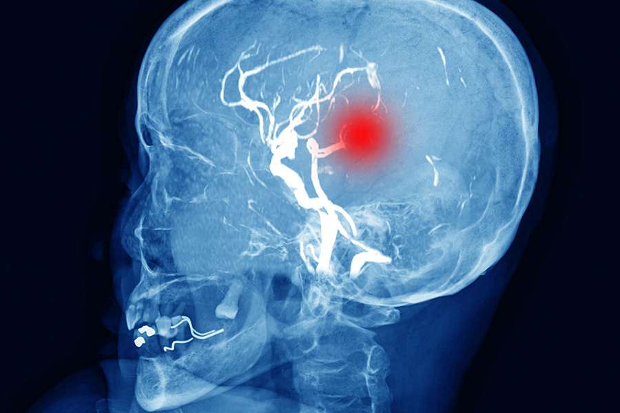 Это геморрагический инсульт, или кровоизлияние в мозг (источник изображения: freepik.com)
