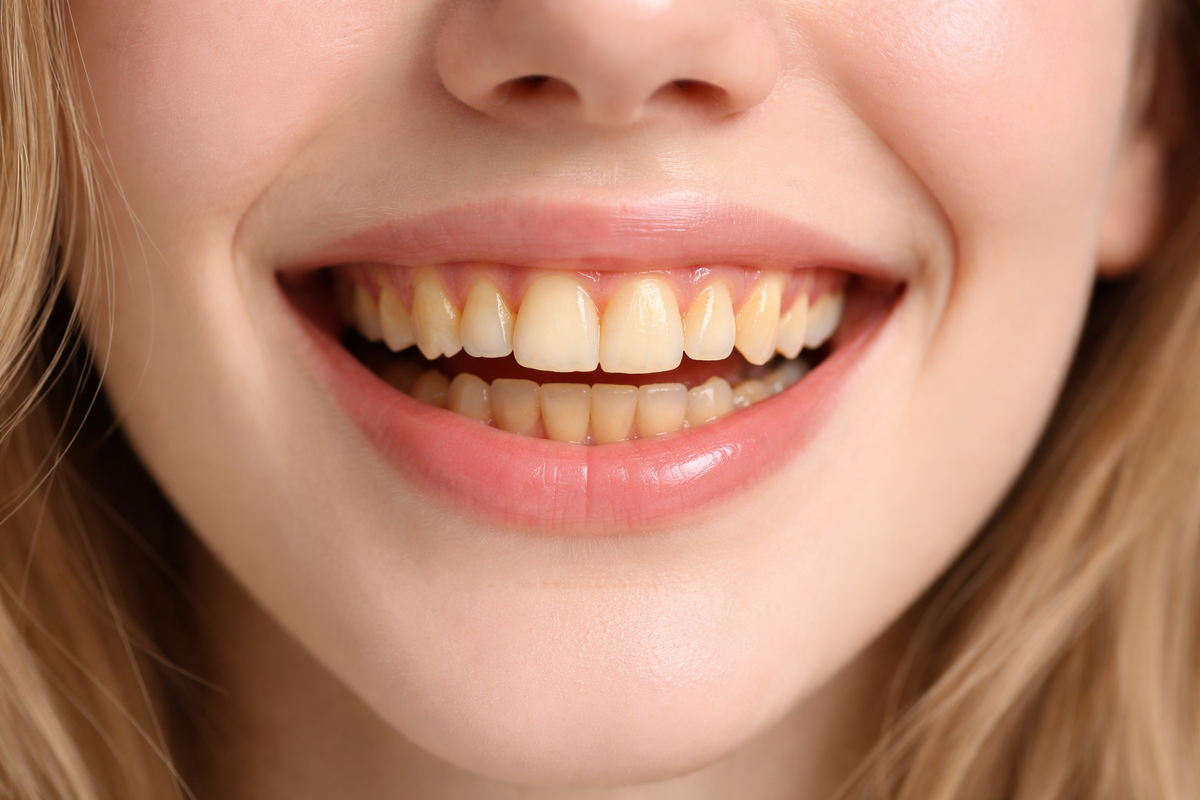 Налет на зубах