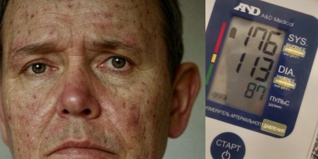 Когда давление не сбивается: как камни и кисты в почках влияют на гипертонию