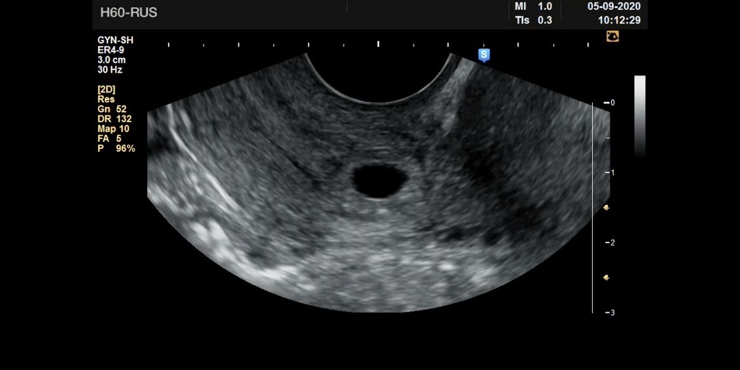 Ошибка УЗИста