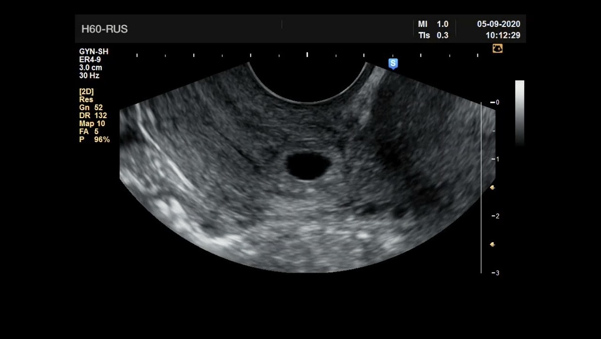 Шеечная беременность малого срока. Фото из телеграм-канала для специалистов УЗД