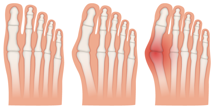 Косточка на большом пальце: в каких случаях операция нужна, а когда - нет
