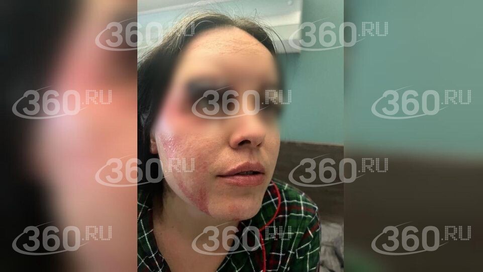    На фото Анастасия Лобода после операции по пересадке кожи в сентябре 2025 года / 360.ru