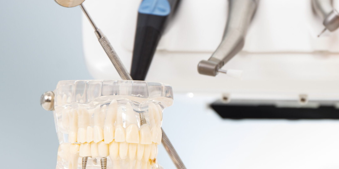 Что делать, если не хватает костной ткани для имплантации?