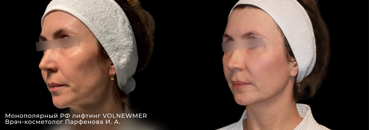 Фото до и после процедуры RF лифтинга Volnewmer в клинике косметологии GEN87