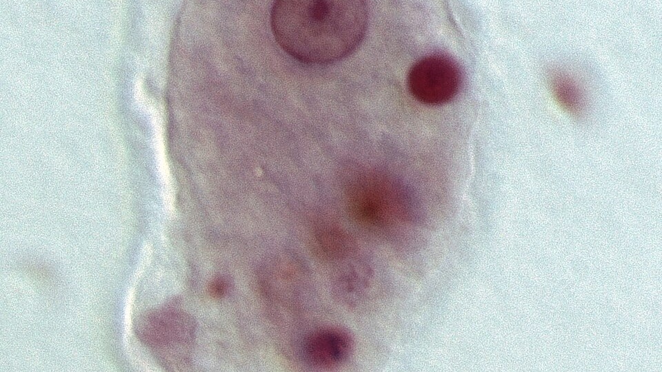 Под маской болезни Крона: что такое амебиаз и как его выявить