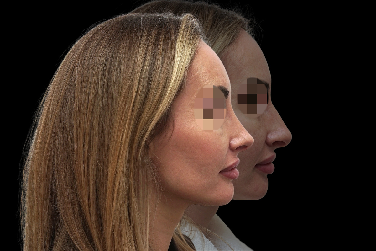 Результат закрытой ринопластики. Пластически хиург Стайсупов В.Ю.