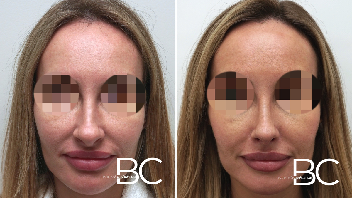 Закрытая ринопластика, до и 3 недели после операции, Хирург Стайсупов В.Ю.